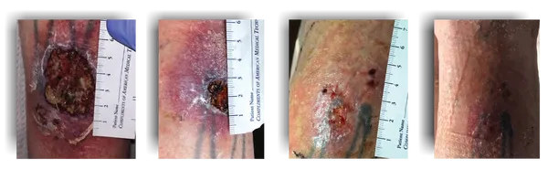 AUTOIMMUNE/VENOUS INSUFFICIENCY