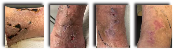 POST OPERATIVE/VENOUS STASIS